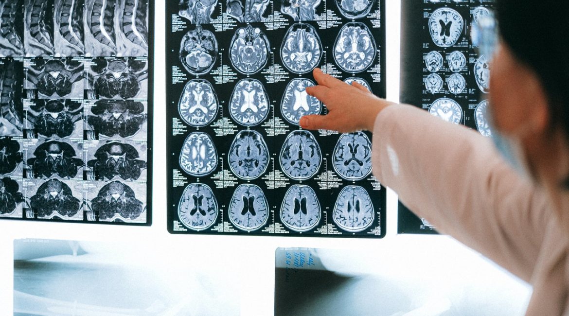 Traumatic Brain Injuries are serious injuries